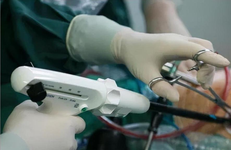 endoscopic stapler doctor(1)